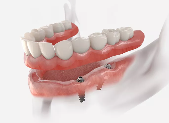 Implant supported denture